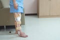 Patient standing with support of knee brace and plaster after pcl ligament knee surgery in orthopedic ward hospital,recovery and Royalty Free Stock Photo