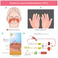 Systemic Lupus Erythematosus SLE. The patients skin inflammation from the light. Illustration.