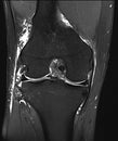 Coronal PD FS MRI of Knee