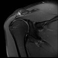 Coronal PD FS MRI of Shoulder