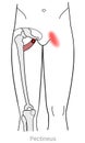 Pectineus muscle myofascial trigger points and groin pain.