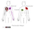 Pectoralis major muscle trigger points may cause pain in the outer shoulder, breast and down the inside of the arm into the hand.