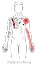 Myofascial trigger points in the Pectoralis minor can cause pain in the shoulder and down the inside of the arm into the hand.