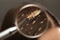 Pediculosis. Woman with lice and nits, closeup. View through magnifying glass on hair