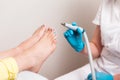 Pedicurist in medical gloves holding a handle of hardware peeling. Close up of female feet with ingrown toenails with