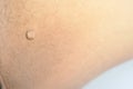 Pedunculated Mass skin tag or acrochondon or soft fibroma. Royalty Free Stock Photo