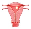 Pedunculated Polyp in the uterus Female reproductive system in cross sections. Front view in a cut. Human anatomy