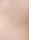 Pedunculated skin tag or acrochondon or soft fibroma. papilloma on human skin. Wart.