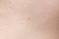 Pedunculated skin tag or acrochondon or soft fibroma. papilloma on human skin. Wart.