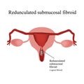 Pedunculated submucous uterine fibroids. Vaginal fibroids. Infographics. Vector illustration on background