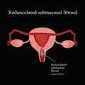 Pedunculated submucous uterine fibroids. Vaginal . Infographics. Vector illustration on a black background Royalty Free Stock Photo