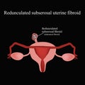 Pedunculated subserous uterine fibroids. Infographics. Vector illustration Royalty Free Stock Photo