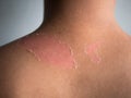 Peeling skin at back and shoulder from sunburn effect on body