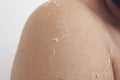 Peeling skin at back and shoulder from sunburn effect on body of young man from sunbath at summer. Royalty Free Stock Photo