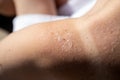 Peeling skin at back and shoulder from sunburn effect