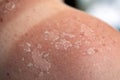 Peeling skin at back and shoulder from sunburn effect