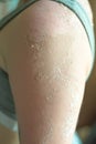 Peeling skin from a bad tan on the arm and forearm, back of the girl causes severe itching Royalty Free Stock Photo