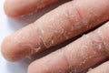 Peeling skin on hand and fingers. Desquamation Royalty Free Stock Photo