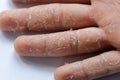 Peeling skin on hand and fingers. Desquamation Royalty Free Stock Photo