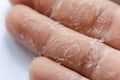 Peeling skin on hand and fingers. Desquamation Royalty Free Stock Photo