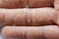 Peeling skin on hand and fingers. Desquamation Royalty Free Stock Photo