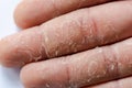 Peeling skin on hand and fingers. Desquamation Royalty Free Stock Photo