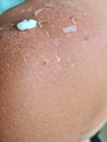 Peeling of skin after sunburn and white cream