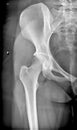 Pelvic bone, Hip Joint Medical Xray