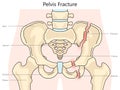 Pelvic fracture structure diagram medical science