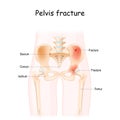 Pelvis Fracture. Vector illustration isolated on a white background