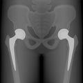 Pelvis and Hip joint problem_Bilateral hip replacement