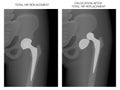 Pelvis and Hip joint problem_Dislocation after total hip replacement