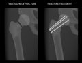 Pelvis and Hip joint problem_Femoral neck fracture treatment in young patients