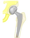 Pelvis and Hip joint problem_Hemiarthroplasty Royalty Free Stock Photo