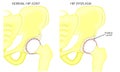 Pelvis and Hip joint problem_Hip dysplasia Royalty Free Stock Photo