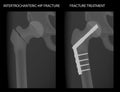 Pelvis and Hip joint problem_Intertrochanteric hip fracture treatment 2