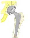 Pelvis and Hip joint problem_Total hip replacement-24 Royalty Free Stock Photo