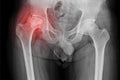 Pelvis and hip x-ray of a patient with hip pain showing avascular necrosis on the right sides of the hips and secondary Royalty Free Stock Photo