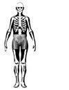 Pelvis and hip x-ray of a patient with hip pain showing avascular necrosis on the left sides of the hips and secondary