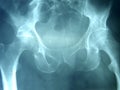 Pelvis X-ray