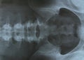 Pelvis x-ray