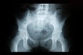 Pelvis X-ray