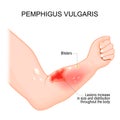 Pemphigus vulgaris. Arm with Blisters