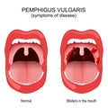 Pemphigus vulgaris. Early symptoms inside the mouth Royalty Free Stock Photo