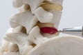 A pen pointing at herniated lumbar disc Royalty Free Stock Photo