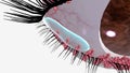 People with blepharitis may experience a gritty or burning sensation in their eyes, excessive tearing, itching,