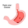 Peptic ulcer disease. Cross section of the humans stomach Royalty Free Stock Photo