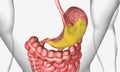 Peptic ulcer disease, is the formation of ulcers in the lining of the stomach and first section of the small intestine