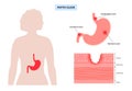 Peptic ulcer disease