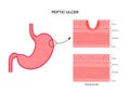 Peptic ulcer disease